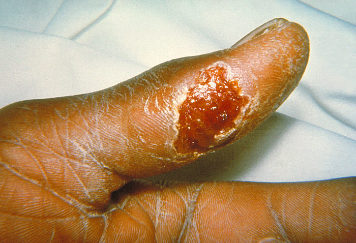 Ulcerative skin lesion caused by tularemia. Photo: CDC/Emory University, Dr. Sellers.